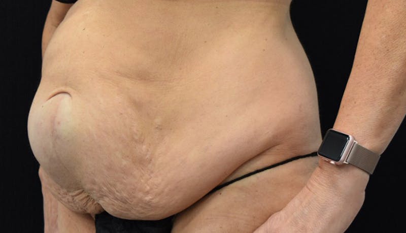Massive Weight Loss Before & After Gallery - Patient 102425115 - Image 3