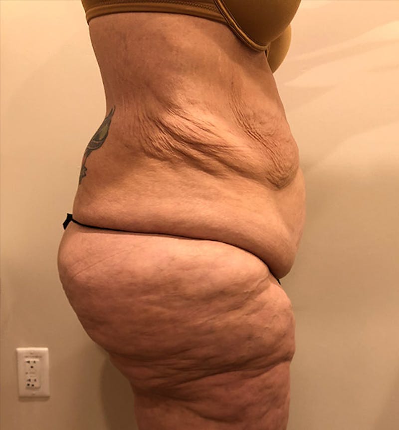 Lower Body Lift Before & After Gallery - Patient 102424252 - Image 3