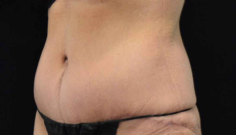 Massive Weight Loss Before & After Gallery - Patient 102425115 - Image 4