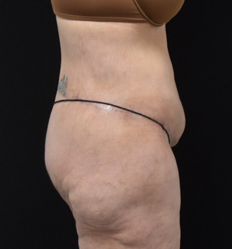 Lower Body Lift Before & After Gallery - Patient 102424252 - Image 4