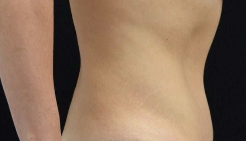 Abdominoplasty Before & After Gallery - Patient 102424251 - Image 8