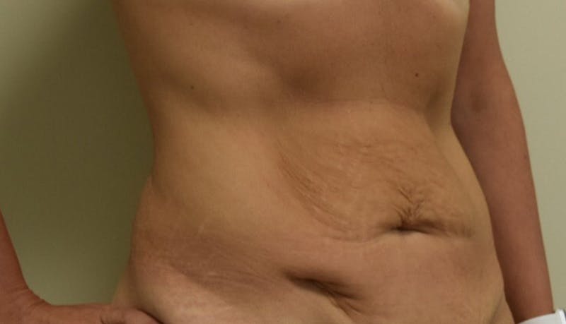 Abdominoplasty Before & After Gallery - Patient 102424251 - Image 9