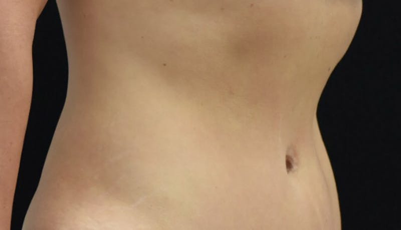 Abdominoplasty Before & After Gallery - Patient 102424251 - Image 10