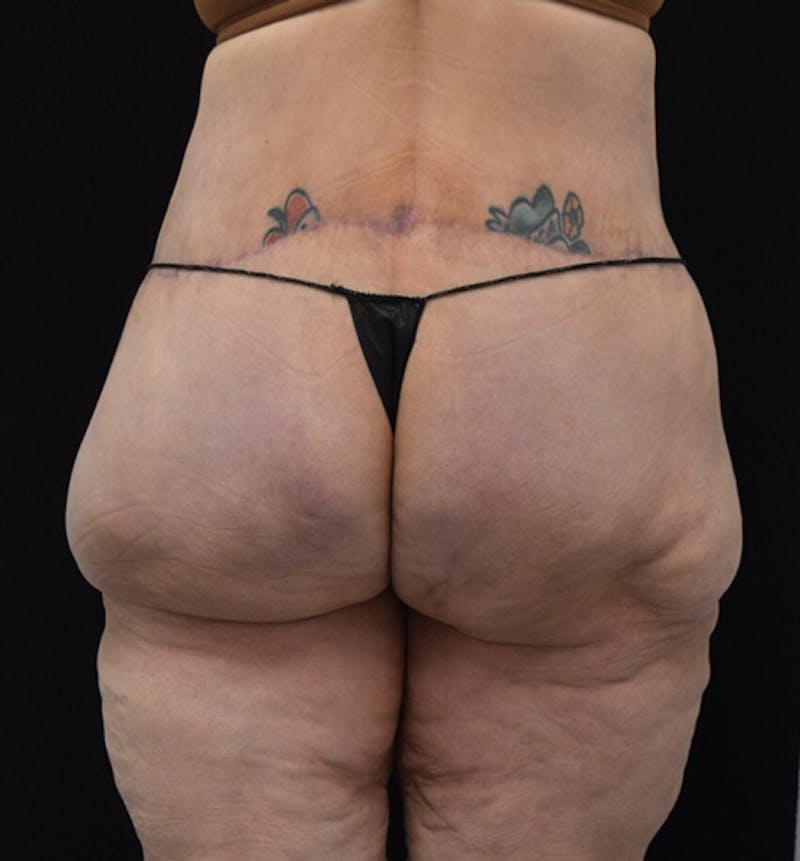 Lower Body Lift Before & After Gallery - Patient 102424252 - Image 10