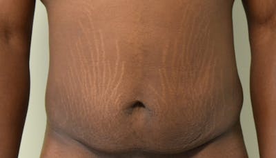 Abdominoplasty Before & After Gallery - Patient 102425119 - Image 1