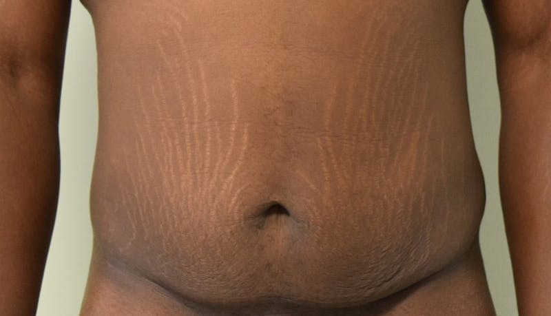 Abdominoplasty Before & After Gallery - Patient 102425119 - Image 1