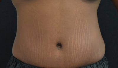 Abdominoplasty Before & After Gallery - Patient 102425119 - Image 2