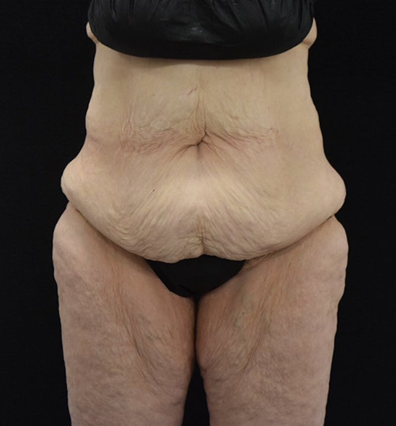 Lower Body Lift Gallery - Patient 102425389 - Image 1