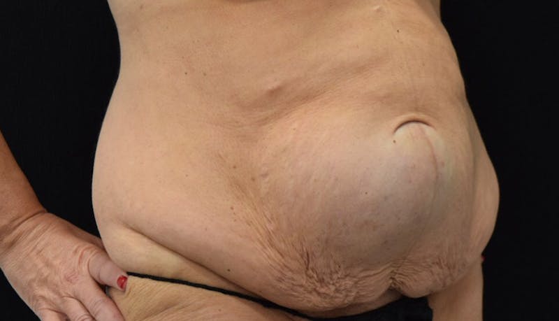 Massive Weight Loss Before & After Gallery - Patient 102425115 - Image 7