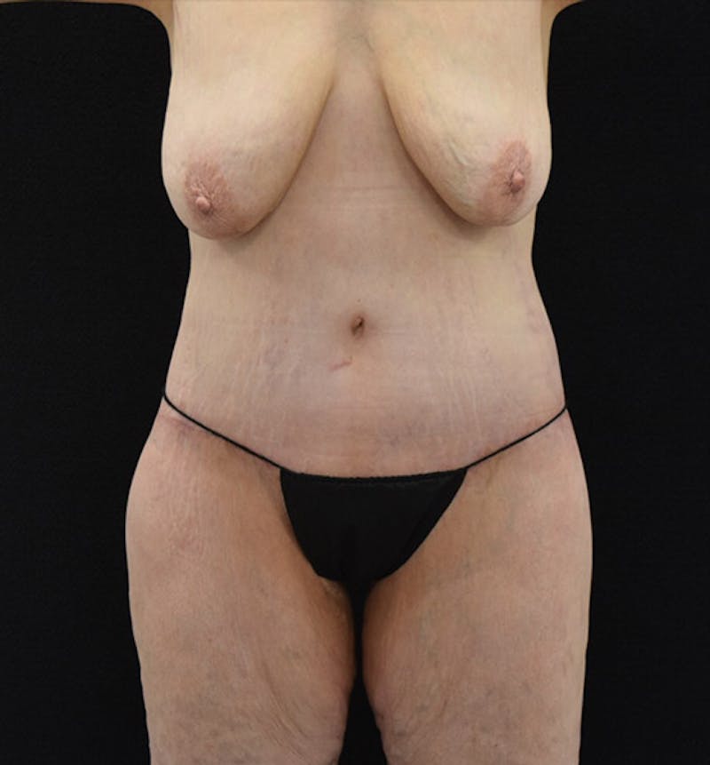 Lower Body Lift Before & After Gallery - Patient 102425389 - Image 2