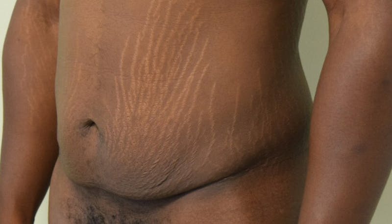 Abdominoplasty Before & After Gallery - Patient 102425119 - Image 3