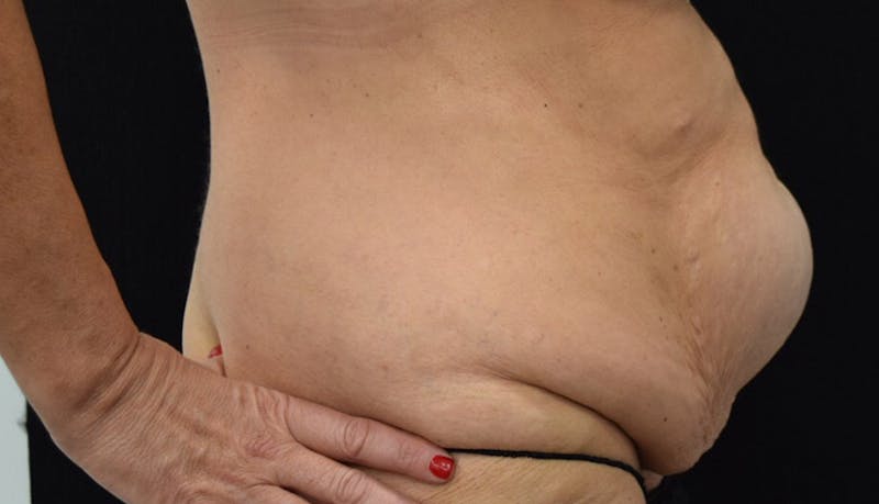 Massive Weight Loss Before & After Gallery - Patient 102425115 - Image 9