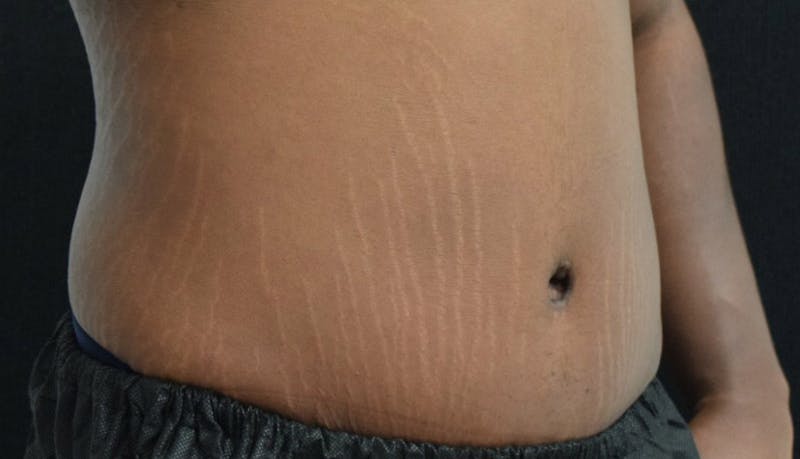Abdominoplasty Before & After Gallery - Patient 102425119 - Image 6