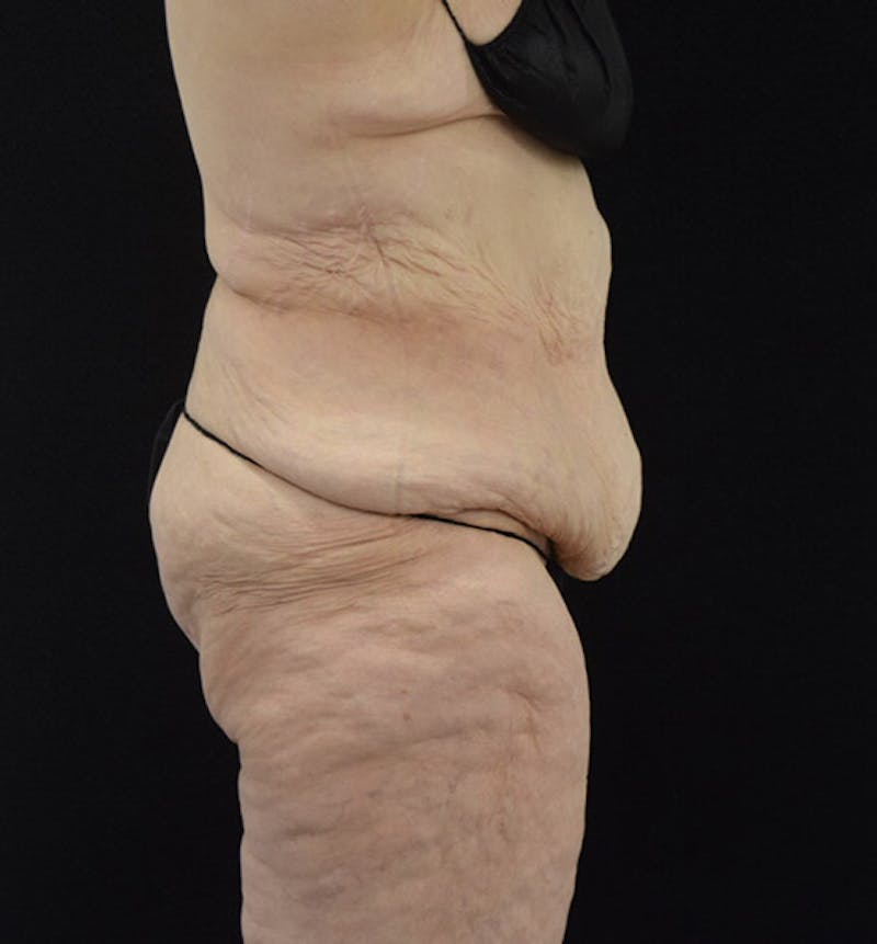 Lower Body Lift Before & After Gallery - Patient 102425389 - Image 5