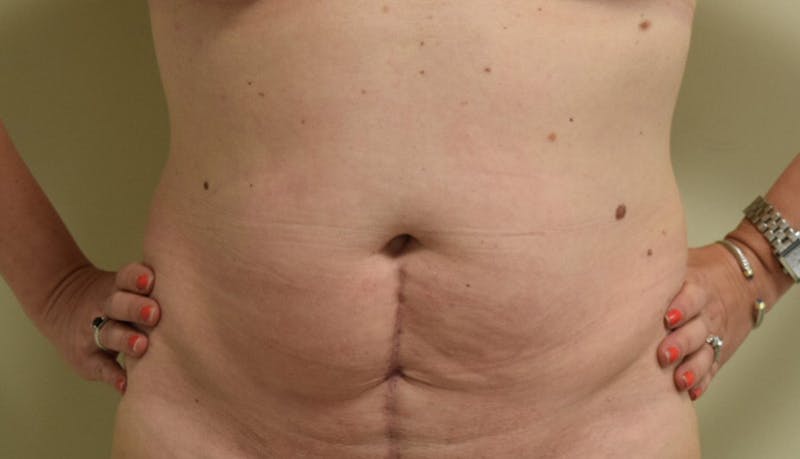 Abdominoplasty Before & After Gallery - Patient 102425391 - Image 1