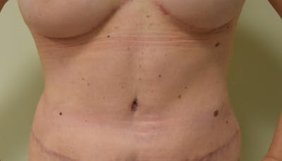 Abdominoplasty Before & After Gallery - Patient 102425391 - Image 2