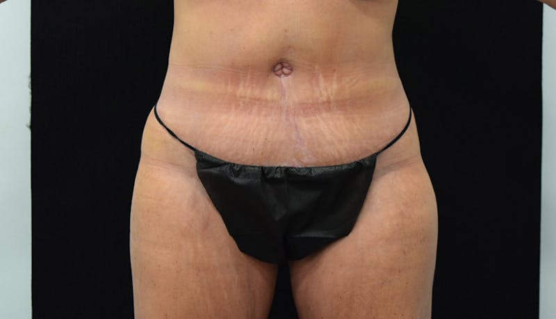 Massive Weight Loss Before & After Gallery - Patient 102425408 - Image 2