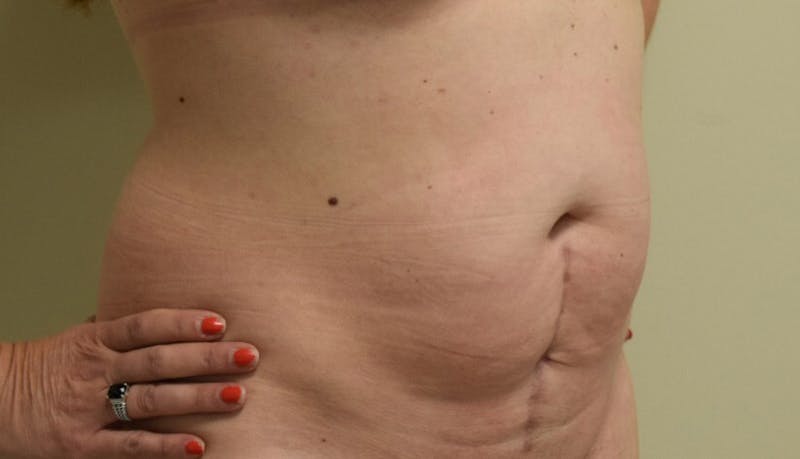 Abdominoplasty Before & After Gallery - Patient 102425391 - Image 3