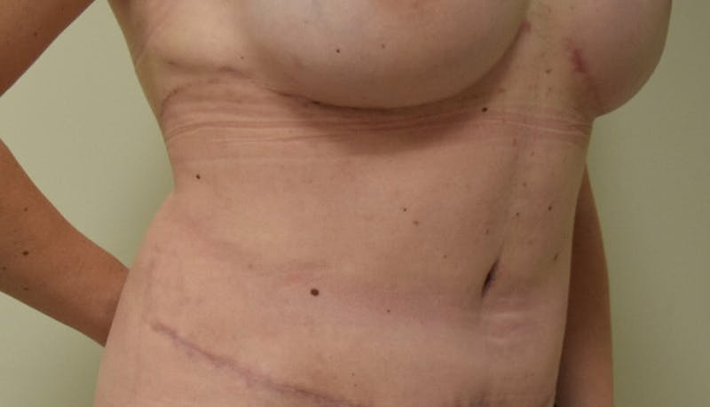 Abdominoplasty Before & After Gallery - Patient 102425391 - Image 4