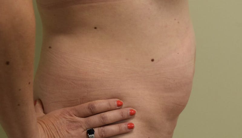 Abdominoplasty Before & After Gallery - Patient 102425391 - Image 5