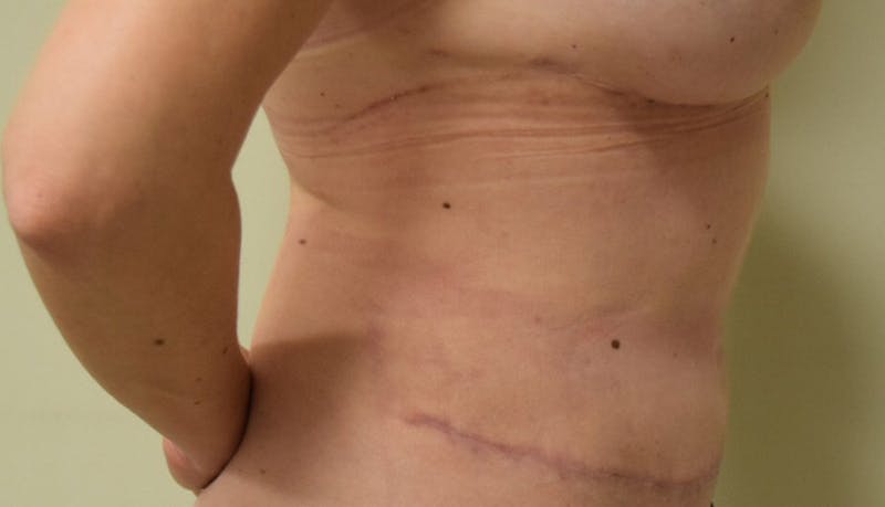 Abdominoplasty Before & After Gallery - Patient 102425391 - Image 6
