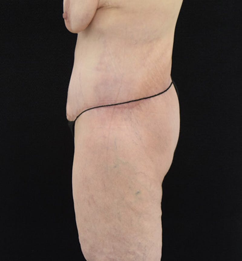Lower Body Lift Before & After Gallery - Patient 102425389 - Image 10