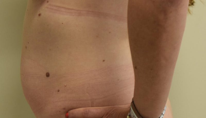 Abdominoplasty Before & After Gallery - Patient 102425391 - Image 7
