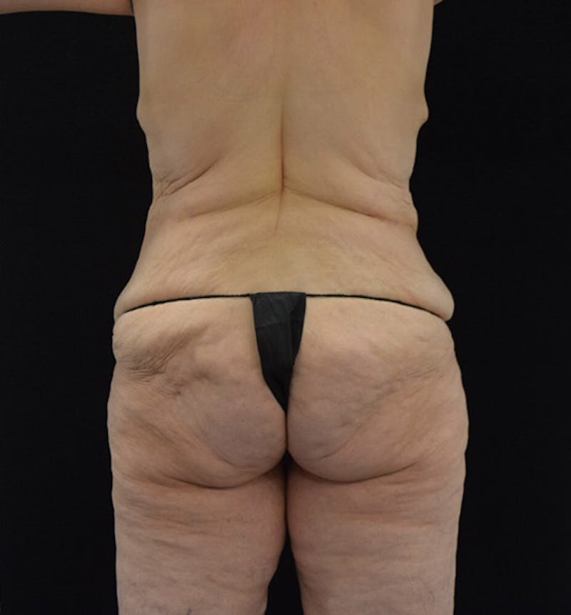 Lower Body Lift Before & After Gallery - Patient 102425389 - Image 11