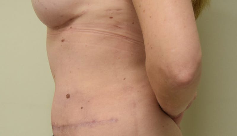 Abdominoplasty Before & After Gallery - Patient 102425391 - Image 8