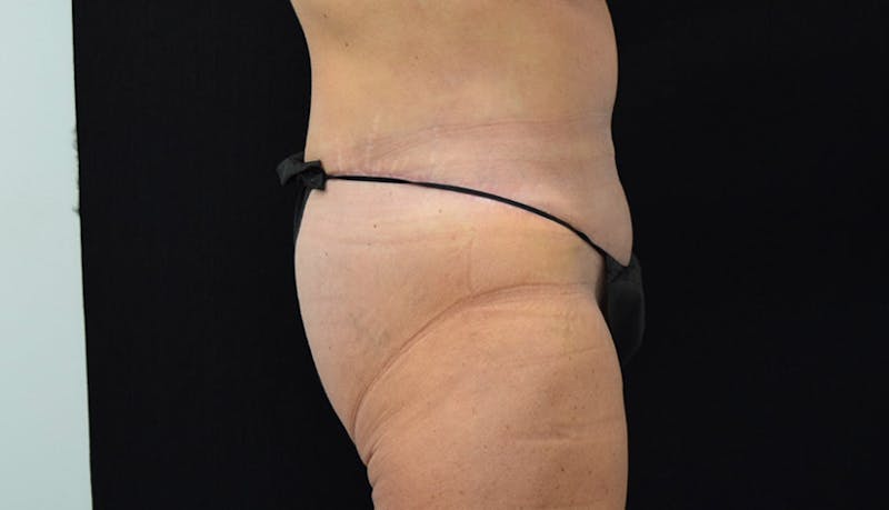 Massive Weight Loss Before & After Gallery - Patient 102425408 - Image 6