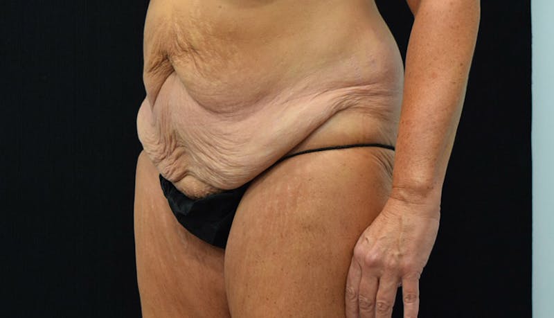 Massive Weight Loss Before & After Gallery - Patient 102425408 - Image 7