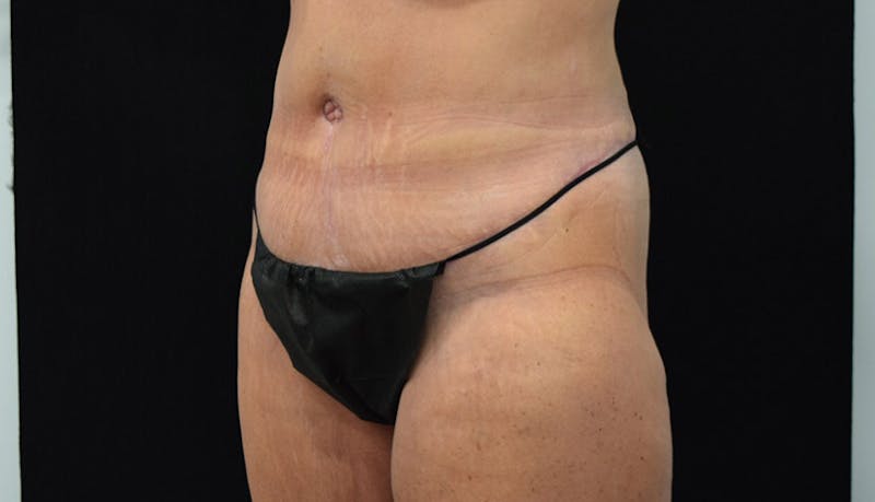 Massive Weight Loss Before & After Gallery - Patient 102425408 - Image 8
