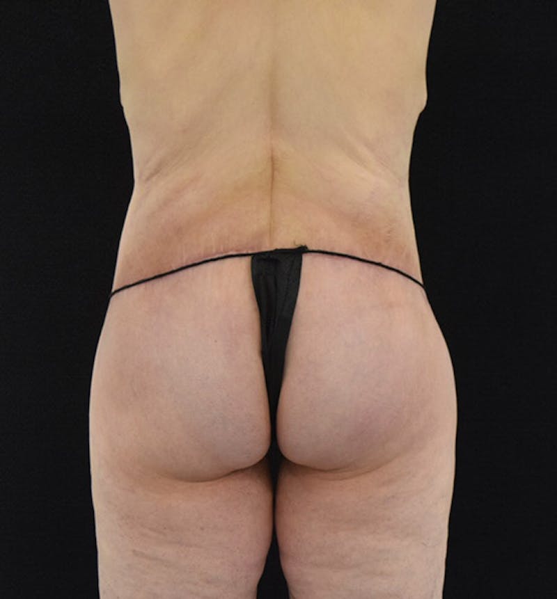 Lower Body Lift Gallery - Patient 102425389 - Image 12