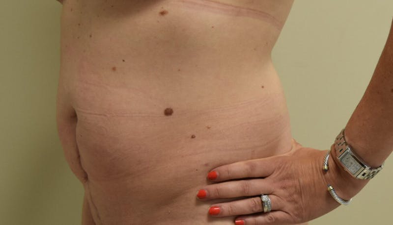 Abdominoplasty Before & After Gallery - Patient 102425391 - Image 9