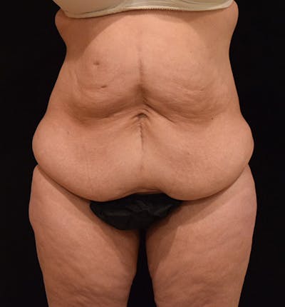 Lower Body Lift Before & After Gallery - Patient 102425579 - Image 1