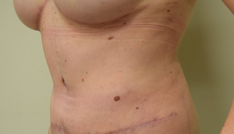 Abdominoplasty Before & After Gallery - Patient 102425391 - Image 10