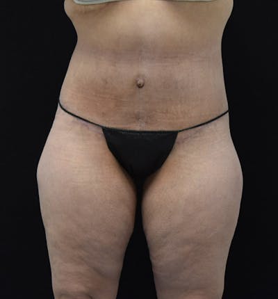 Lower Body Lift Before & After Gallery - Patient 102425579 - Image 2