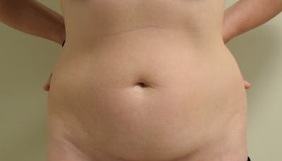 Abdominoplasty Before & After Gallery - Patient 102425575 - Image 1