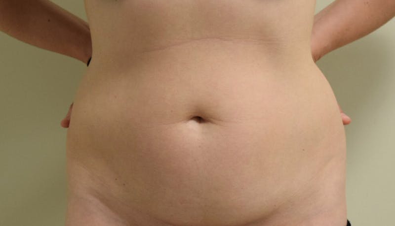 Abdominoplasty Before & After Gallery - Patient 102425575 - Image 1