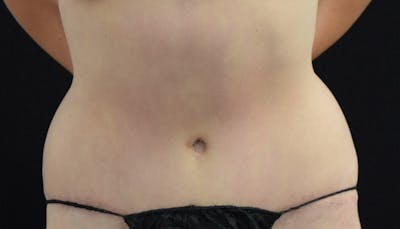 Abdominoplasty Before & After Gallery - Patient 102425575 - Image 2