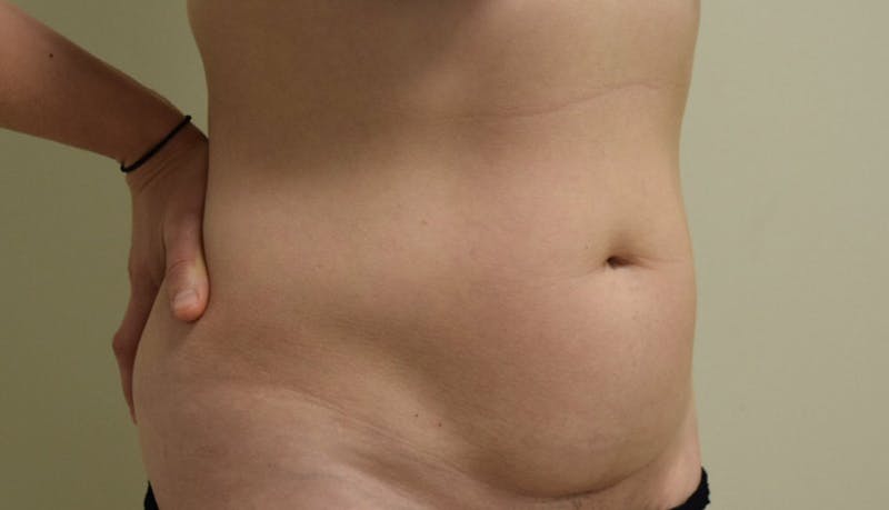 Abdominoplasty Before & After Gallery - Patient 102425575 - Image 3