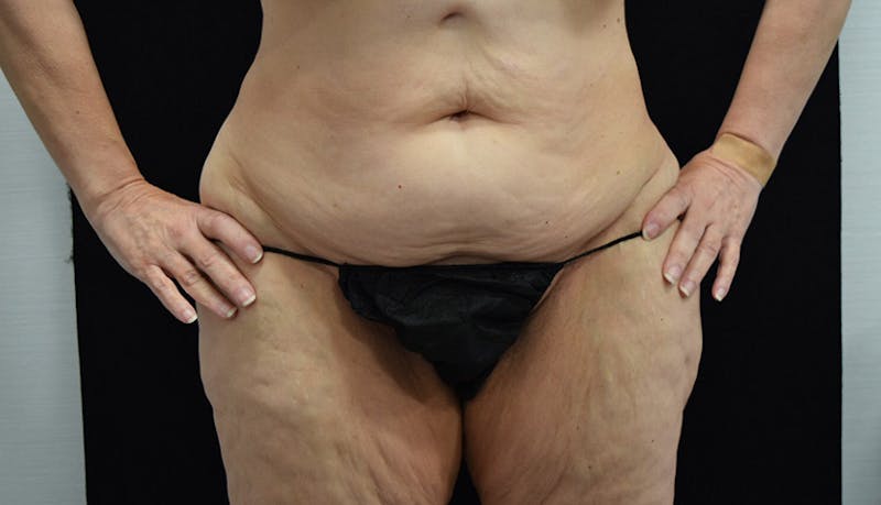 Massive Weight Loss Before & After Gallery - Patient 102425578 - Image 1