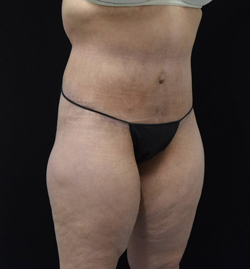 Lower Body Lift Gallery - Patient 102425579 - Image 4