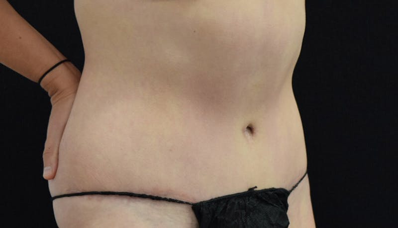 Abdominoplasty Before & After Gallery - Patient 102425575 - Image 4