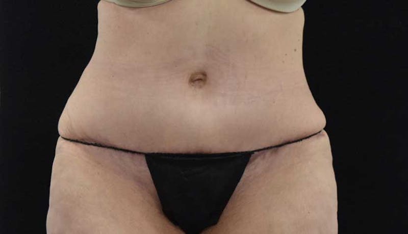 Massive Weight Loss Before & After Gallery - Patient 102425578 - Image 2