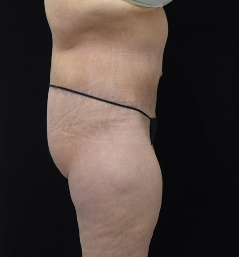 Lower Body Lift Before & After Gallery - Patient 102425579 - Image 6