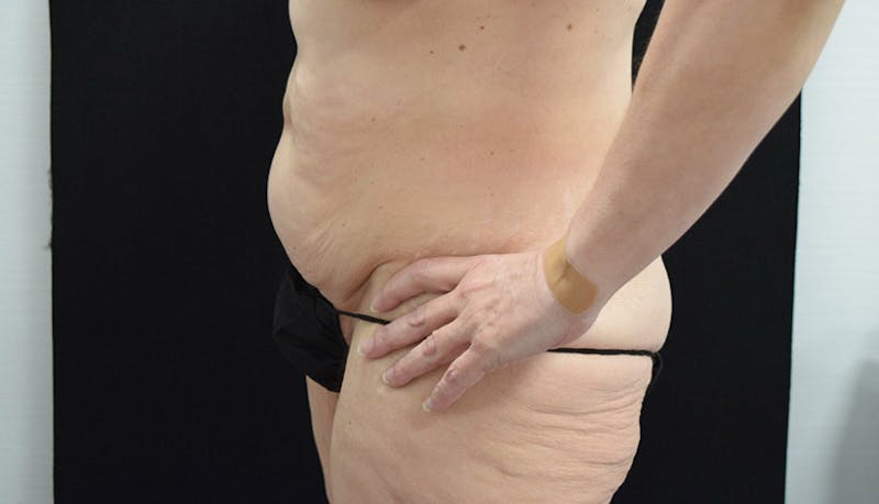 Massive Weight Loss Before & After Gallery - Patient 102425578 - Image 3