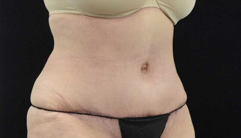 Massive Weight Loss Before & After Gallery - Patient 102425578 - Image 6