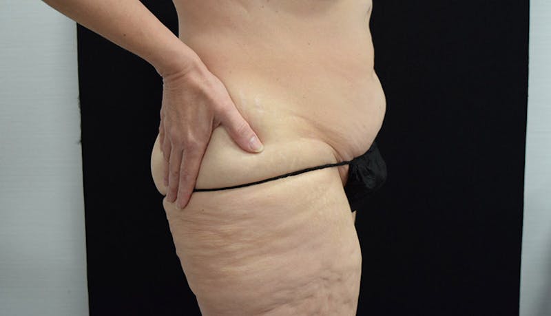 Massive Weight Loss Before & After Gallery - Patient 102425578 - Image 7