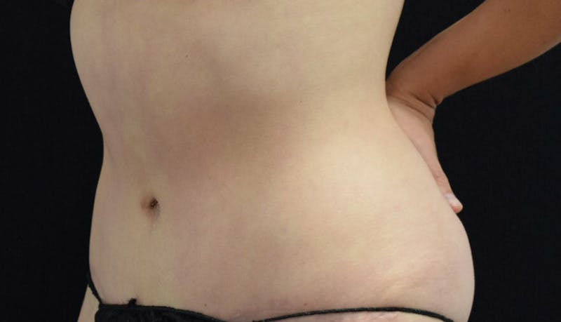 Abdominoplasty Before & After Gallery - Patient 102425575 - Image 6